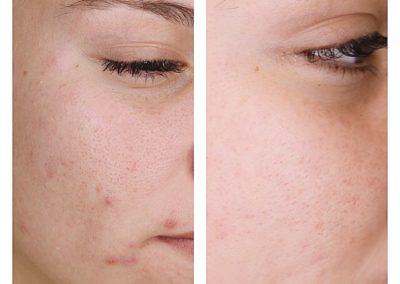 Microneedling Acne & Acne Scars Treatment