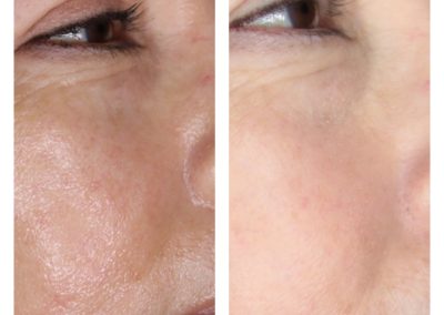 Microneedling Rosacea Treatment & Pore Size Reduction Before & After 1 procedure