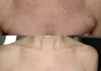 Microneedling Décolletage Before & After 4 treatments