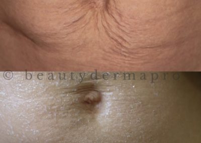 Microneedling Stretch Marks Before & After 2 procedures