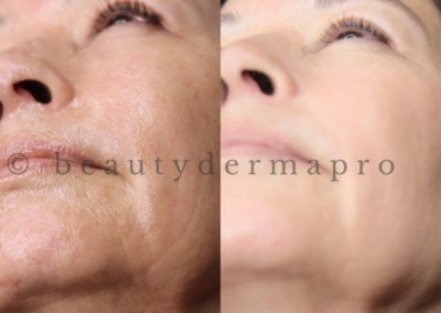 Microneedling Full Face Before & After 1 procedure